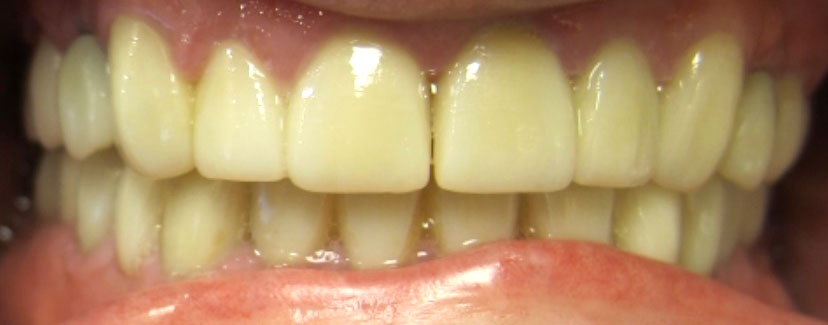 After Cosmetic Dentistry In Lansdale, PA
