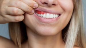 From Mild to Severe: How Gum Disease Progresses